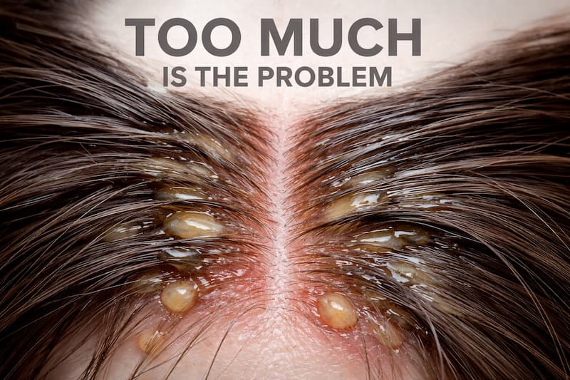 overloaded scalp with product buildup