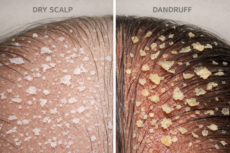 dry scalp vs dandruff (2)