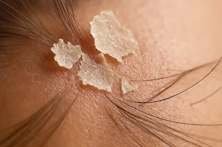 Flaky scalp during cold weather